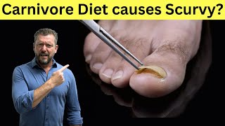 Does the Carnivore Diet cause Scurvy Dietitian vs Doctor [upl. by Bertie]