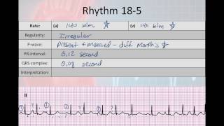 Basic Electrophysiology part 7  Atrial Rhyhtms part 2 WAP MAT EAT SVT [upl. by Leahcimaj]