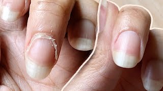 How to TREAT Fungal Nail  Get Rid Of Nail Fungus AntiFungal Lacquer amp Tablets [upl. by Naryb]