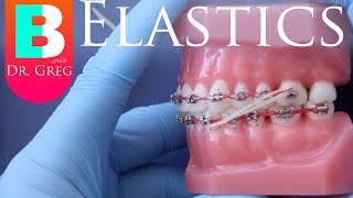 BRACES EXPLAINED Elastics  Rubber Bands [upl. by Jakie]