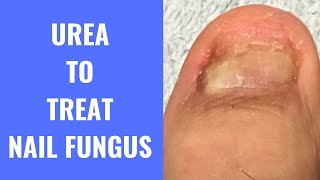 Use Urea To Treat Nail Fungus [upl. by Ghassan]