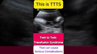 TTTS  Twin to Twin Transfusion Syndrome Ultrasound  Monochorionic TWINS [upl. by Ennaerb635]