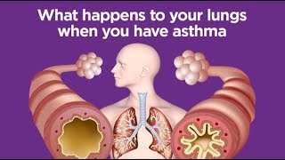 Chest Infection vs Asthma Attack How to Tell Them Apart [upl. by Nnalyrehs]