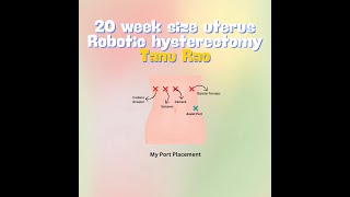 20 week size Robotic Hysterectomy [upl. by Spatz791]