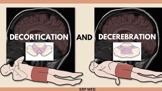 Decerebration vs Decortication  Understanding Neurological Postures amp Brain Damage [upl. by Artur942]