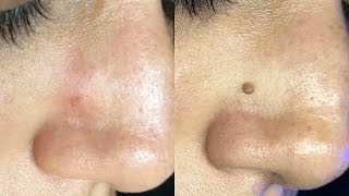 Removing a mole with plasma Fibroblast video before and after [upl. by Llekcor808]