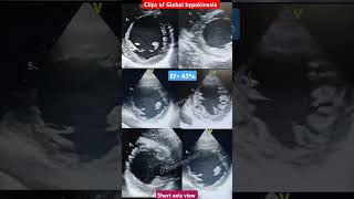 Echo Clips of Global hypokinesia l weak Heart l इको टेस्ट echo shorts [upl. by Antons]