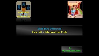 Ultrasound Case 23  Fibromatosis Colli [upl. by Calderon]