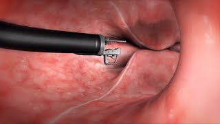 What Happens During the Endoscopic Sleeve Gastroplasty ESG Procedure [upl. by Yarw849]