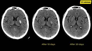 Stages of intracerebral hemorrhage in CT [upl. by Ialda]