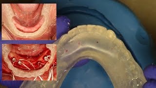 Easy Clinical amp Laboratory Technique for Fabricating an quotInHouse Surgical Guidequot for Overdentures [upl. by Michon]