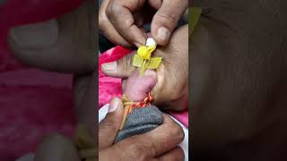 iv cannula kaise lagate hain intravenous cannulation shortsfeed [upl. by Aicertal]