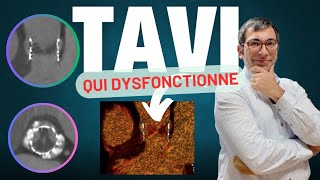 Une valve TAVI qui dysfonctionne après 2 ans  thrombose ou endocardite [upl. by Woolcott]