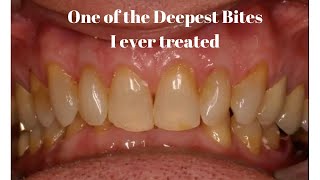 One of the Deepest Bite cases I ever solved [upl. by Hazlip]