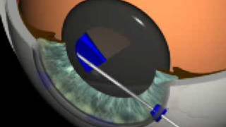 Cataract Surgery 3D Animation O Findl MD Vienna [upl. by Niroc]