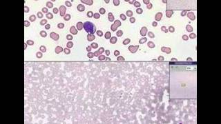 Histopathology Blood Acute leukemia [upl. by Enwahs611]