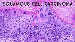 Squamous cell carcinoma in situ with massive pleomorphism pathology dermpath dermatology USMLE [upl. by Arel]