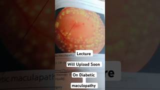 Diabetic maculopathy  Lecture Will Uploaded Soon diabeticretinopathy [upl. by Yeleek]