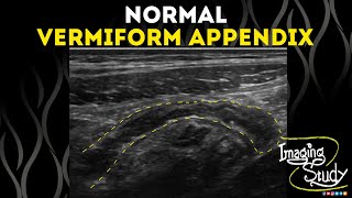 Normal Vermiform Appendix  Ultrasound  Case 50 [upl. by Alegre]