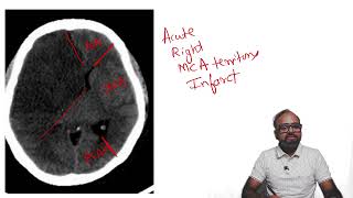 SPOTTERZ  03  Brain hypodensity in a typical vascular territory [upl. by Carena248]