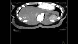 Abdomen Liver Hemangioma of the Liver4 of 8 [upl. by Hars]