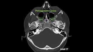 🌺 An anatomical reminder4🌺Foramen Rotundum and Pterygopalatine Fossa🎯Axial and coronal CT image [upl. by Enitselec]