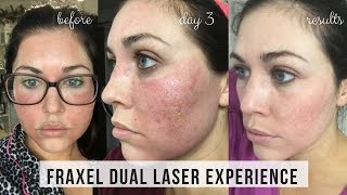 FRAXEL DUAL LASER TREATMENT FOR ACNE SCARS  DAY BY DAY RESULTS  KAILYN CASH [upl. by Nosbig]