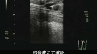 下肢静脈瘤のレーザーストリッピング レーザー焼灼術の動画 [upl. by Kotto]