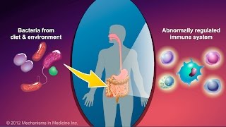 What is Crohns Disease [upl. by Tillio]