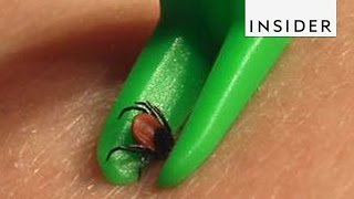 How To Remove Ticks [upl. by Aneloaup]