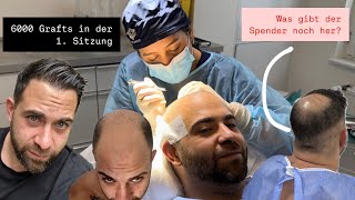 1 Haartransplantation war nicht ausreichend mit 6000 Grafts [upl. by Kloster]