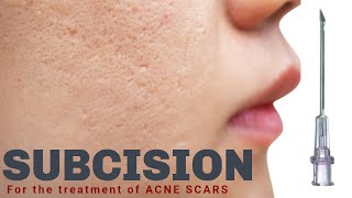 Subcision for Acne Scars  Advanced Dermatology amp Laser Institute of Seattle [upl. by Kennan]