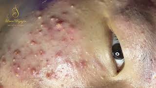 Loan Nguyen Acne Treatment 358pre [upl. by Ecnav]