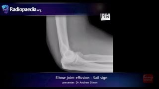 Elbow joint effusion and the sail sign  radiology video tutorial xray [upl. by Wyatan]