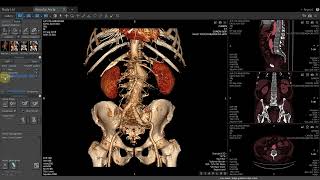 Vitrea Demonstrations  Vascular Aorta [upl. by Annelg]