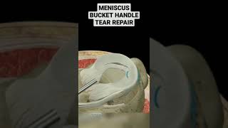 Meniscus Tear Repair meniscus meniscustear repair physicaltherapy kneepain anatomykneeanatomy [upl. by Custer]