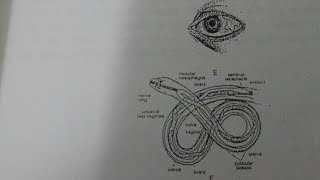 Loa loa Eye worm دودة العين الأفريقية د نرمين خالد [upl. by Ymereg]