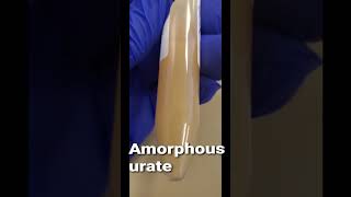 Amorphous urate urine [upl. by Felt]