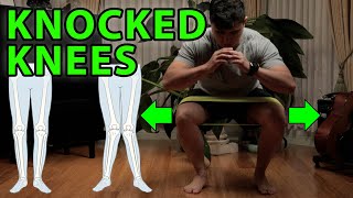 3 Power Exercises For Knocked Knees  Genu Valgus Flat Feet [upl. by Schnell]