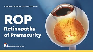 Retinopathy of Prematurity Diagnosis and Treatment [upl. by Ecnerolf]