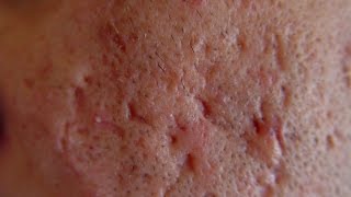 What Causes Acne Scars DermTVcom Epi 563 [upl. by Bethesda]