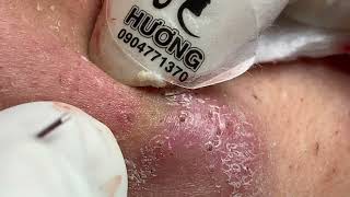 Make your Acne Treatment Huong Da Nang  479 acne 2022 [upl. by Tamer]