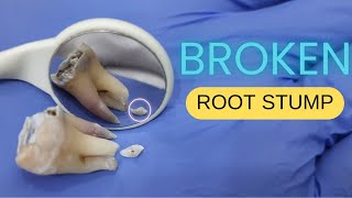 BROKEN ROOT STUMP  When to remove and When to leave  Hindi [upl. by Eniawed719]