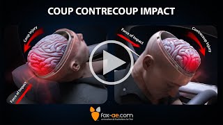 Coup  Contrecoup Impact [upl. by Bunni]