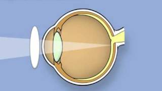 Retinoscopy of the eye Ophthalmology [upl. by Raney883]