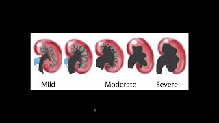 Hydronephrosis  Ultrasound [upl. by Milda944]