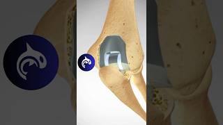 Total Elbow Replacement TER anatomy elbow surgery [upl. by Ecarret516]