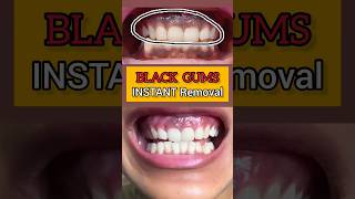 BLACK GUMS Instant Removal Laser Depigmentation Dr Srishti Bhatia smilemakeover [upl. by Lyrrehs]