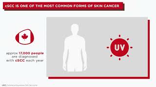 Helping you Understand cutaneous Squamous Cell Carcinoma [upl. by Dewie]