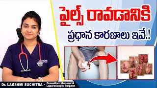 పైల్స్ ఎందుకు వస్తుంది  What Is Piles  Causes of Piles In Telugu  Hemorrhoids  Sankhya Hospital [upl. by Shulem]